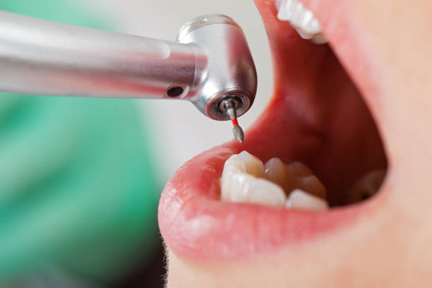Best Emergency Dental Care for Broken or Chipped Teeth in Sudley, VA